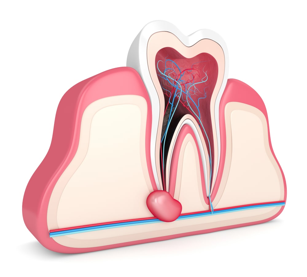 Un abcès dentaire à l'extrémité d'une racine dentaire