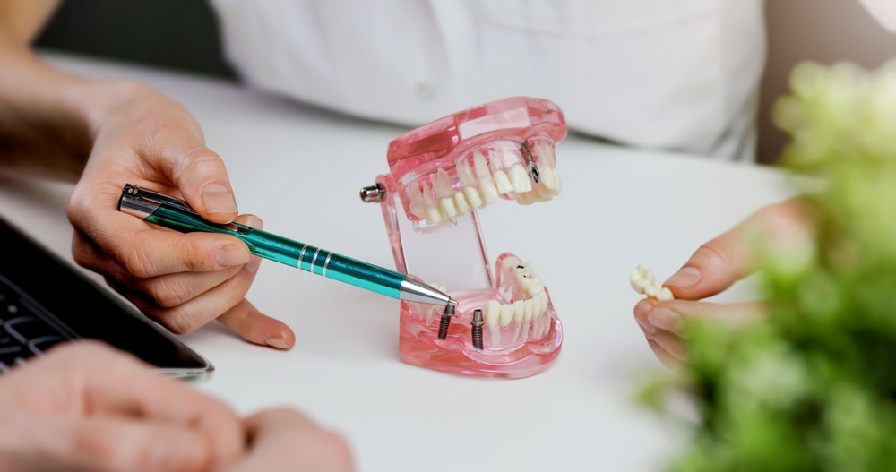 Un modèle d'implantologie avec des implants dentaires