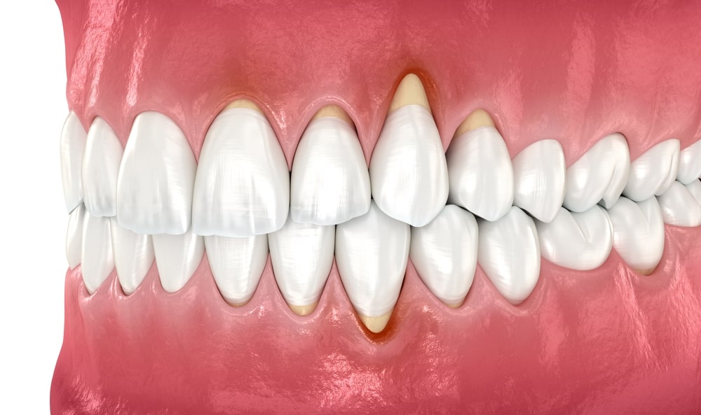 L'illustration du retrait des gencives au niveau de certaines dents
